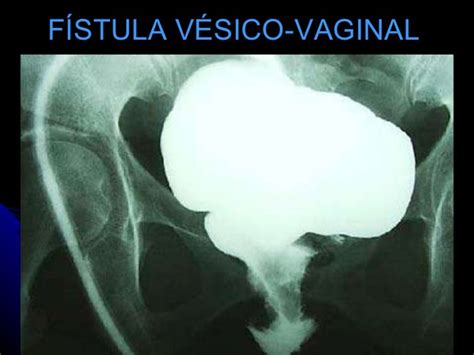 Fístula Vesíco-Vaginal