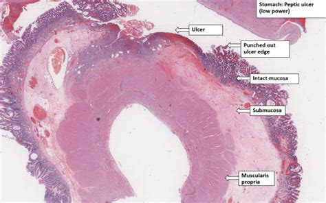 Stomach – Chronic peptic ulcer – NUS Pathweb :: NUS Pathweb