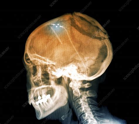 Ventricular shunt in brain tumour, X-ray - Stock Image - C026/9905 - Science Photo Library