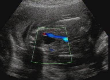 Ultrasound of Single Umbilical Artery Pregnancy Gender Reveal ...