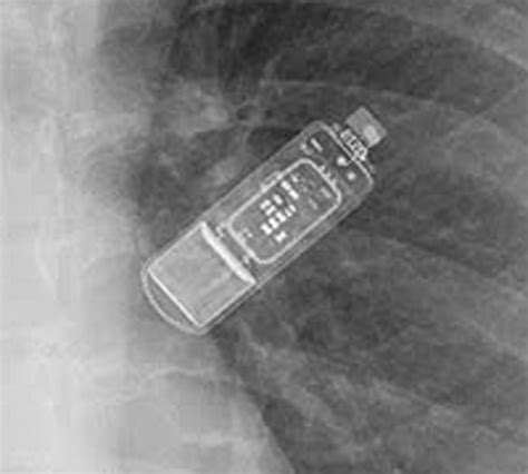 MR safety: loop recorders - Questions and Answers in MRI