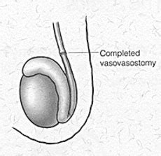 Vasectomy Reversal - Institute for Reproductive Health