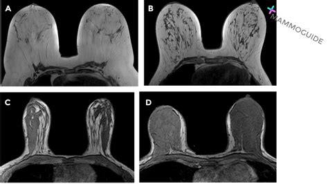 Amount of Fibroglandular Tissue on MRI - MAMMOGUIDE - Learn Breast Imaging