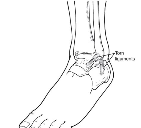 San Diego Chargers Ankle Injuries - Foot Doctor San Diego / La Jolla ...