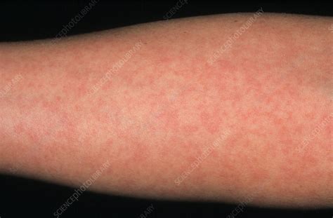 Arm of woman showing German measles rash - Stock Image - M210/0128 - Science Photo Library