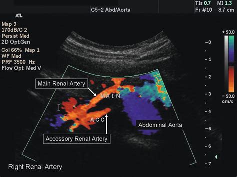 Renal Artery Stenosis Protocol Ultrasound