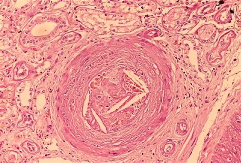 VLDL Cholesterol: Levels, Origin and Components, Differences With LDL ...