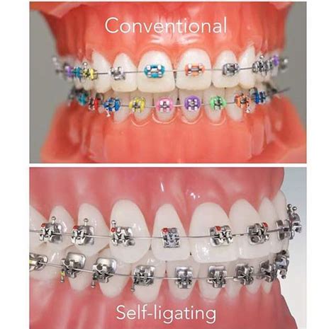 Braces: Conventional VS Self-Ligating