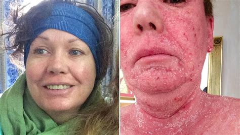 This Woman's Skin Peeled Off Due to Her Topical Steroid Cream Addiction | Allure