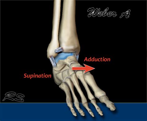 The Radiology Assistant : Ankle fracture - Weber and Lauge-Hansen ...