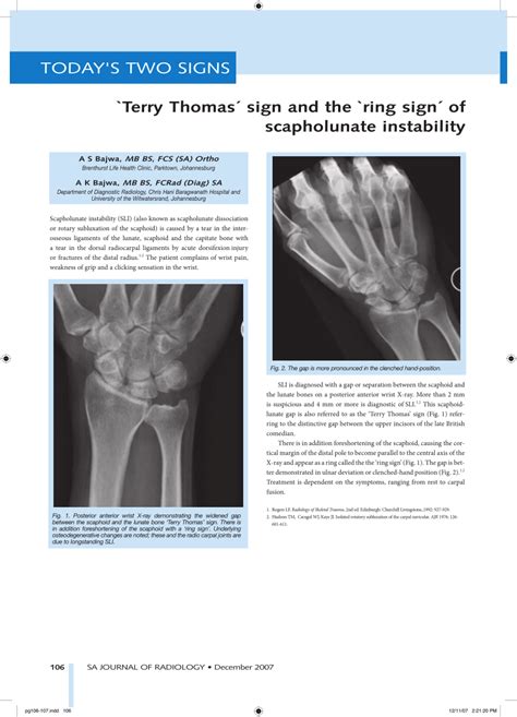 (PDF) Terry Thomas sign and the ring sign of scapholunate instability