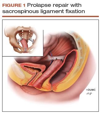 Pelvic Floor Prolapse Surgery Recovery Time | Review Home Co