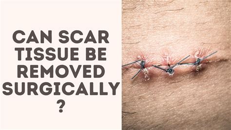 Can Scar Tissue Be Removed Surgically - Treat Your Scars