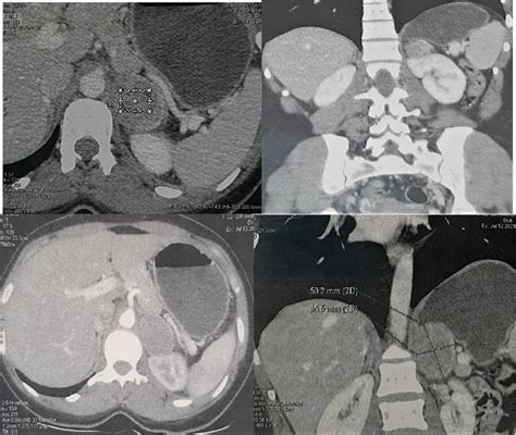 CT-Tomography showed the pheochromocytoma. | Download Scientific Diagram