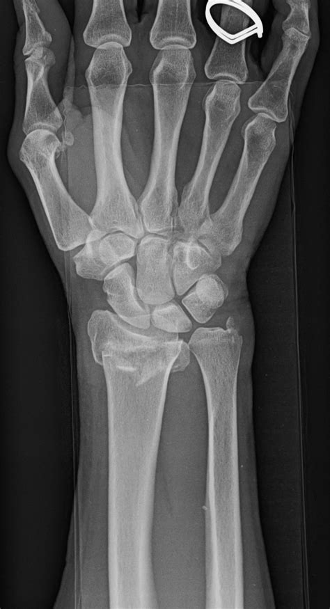 Broken Wrist Treatment in Raleigh, NC - John Erickson, MD