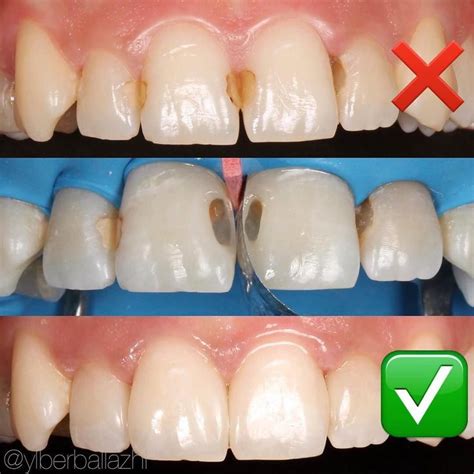 Some lovely front teeth h white fillings by Dr @ylberballazhi . Great work doc! Creating ...