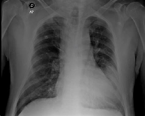 CHEST X-RAY. Widened mediastinum and retrocardiac opacity showing no... | Download Scientific ...