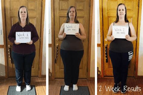 Week 2 - Gastric Sleeve Results