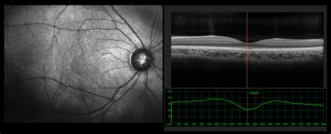 Retinal Tomography | Eye Patient