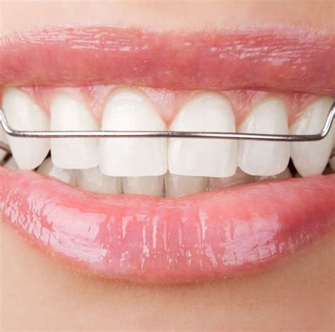 Inman Aligner London | Flexible & Removable Braces | Ten Dental