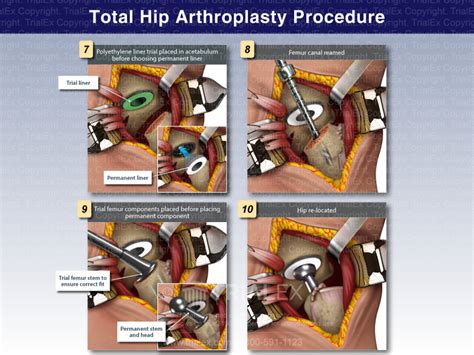 Total Hip Arthroplasty Procedure - Trial Exhibits Inc.