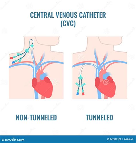 Central Line Venous Catheter Types On Male Body Cartoon Vector ...