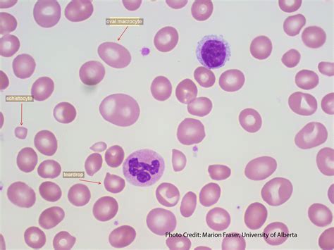 Megaloblastic Anemia Peripheral Smear