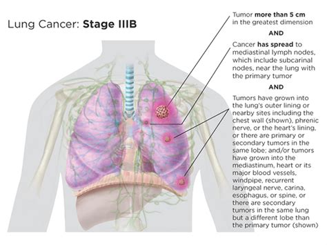 Lung Cancer Staging | LUNGevity Foundation