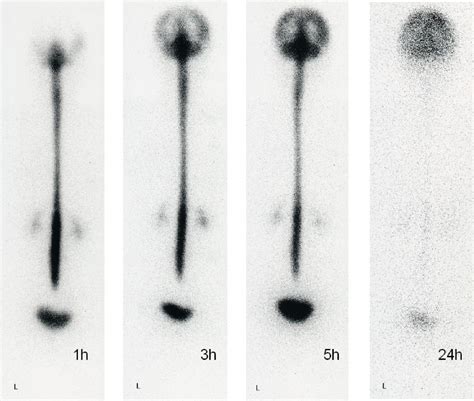 Cerebrospinal fluid leakage after radioisotope cisternography is not influenced by needle size ...