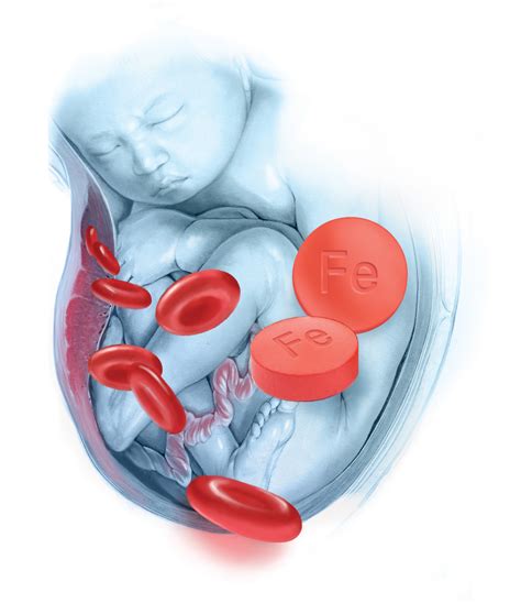 Recognize and treat iron deficiency anemia in pregnant women | MDedge ObGyn