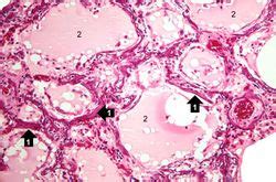 IPLab:Lab 2:Metastatic Calcification - Pathology Education Instructional Resource