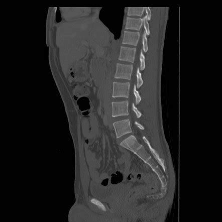 Dislocation Of Coccyx Rectal