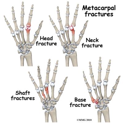 Metacarpal Fracture | Symptoms, treatment, surgery & rehabilitation