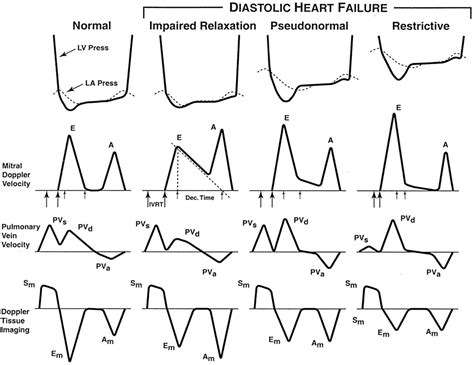 Frontiers | Assessment of Diastolic Function in Congenital Heart Disease