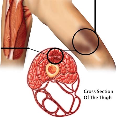 Dead Leg (Quadriceps Contusion) | Sportnova UK