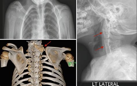 Evidence-Based Treatment of Sprengel Deformity | Musculoskeletal Key