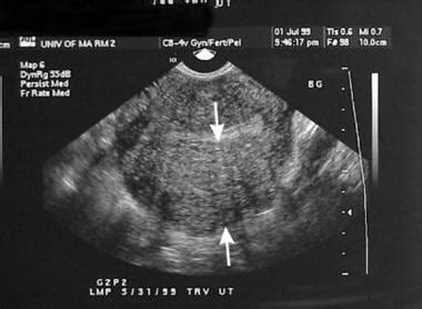 Adenomyosis Imaging: Practice Essentials, Magnetic Resonance Imaging, Ultrasonography