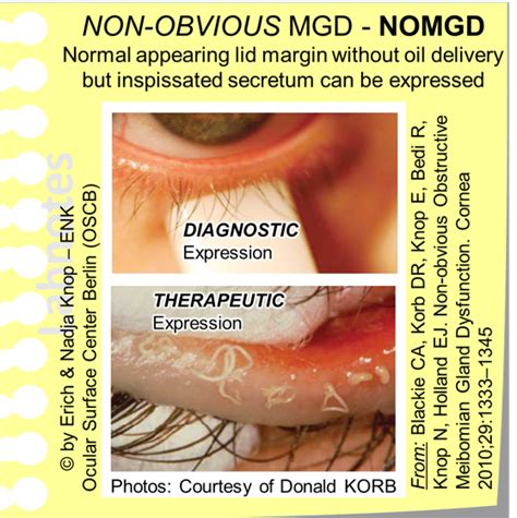 Meibomian Gland Dysfunction (MGD) — Ocular Surface Center Berlin