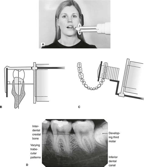 Periapical X Ray