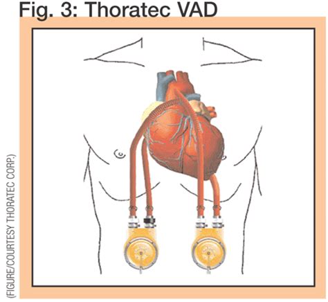 Alphabet soup: CHF, LVAD,BiVAD: Now for the BiVAD