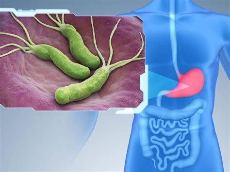 Helicobacter pylori (H. pylori) and Cancer - NCI