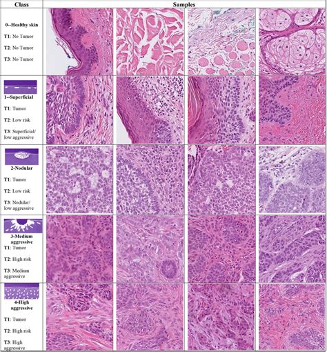 Samples of BCC subtypes used in the three classification tasks (T): T1... | Download Scientific ...