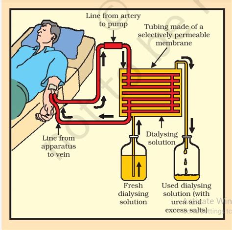 The dialysis machine consists of tubes with a lining, which are ...