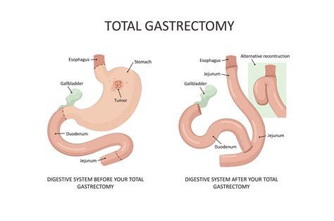 Partial Gastrectomy