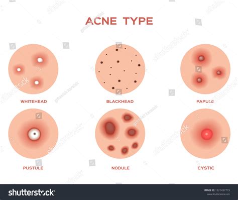 11,264 Pimple Vector Images, Stock Photos & Vectors | Shutterstock