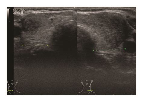 Ultrasonography of the thyroid. (a) Heterogeneous and hypoechoic areas... | Download Scientific ...