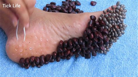 OMG! How to remove many ticks style on feet human | Designed from tamarind seeds and cereals ...