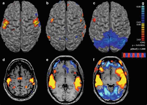 Use of fMRI Activation Paradigms: A Presurgical Tool for Mapping Brain ...