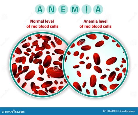 Anemia Level of Blood Cells Stock Vector - Illustration of compare ...