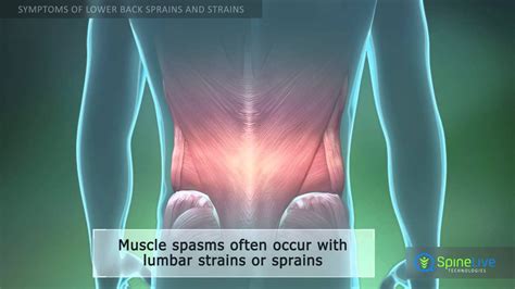 Lumbosacral Ligament Strain